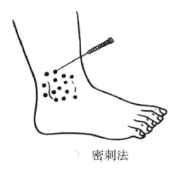 密刺法
