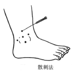 散刺法