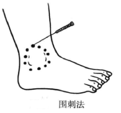 围刺法