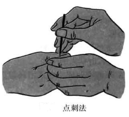 点刺法