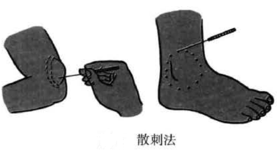 散刺法
