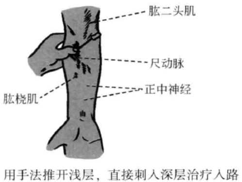 用手法惟开浅层，直接刺入深层治疗入路