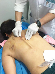 张氏筋膜松解针