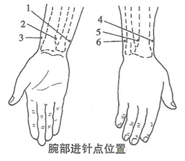 腕踝针进针点及其适应证